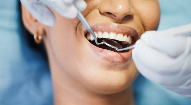 Best Knocked-Out Tooth (Avulsed Tooth) Treatment in New Carlisle, OH